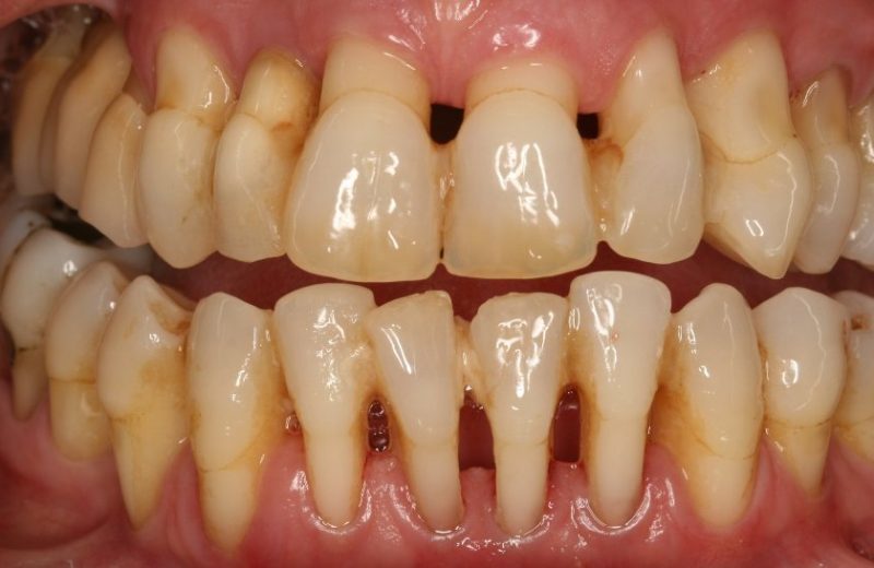 periodontitis periodontitis